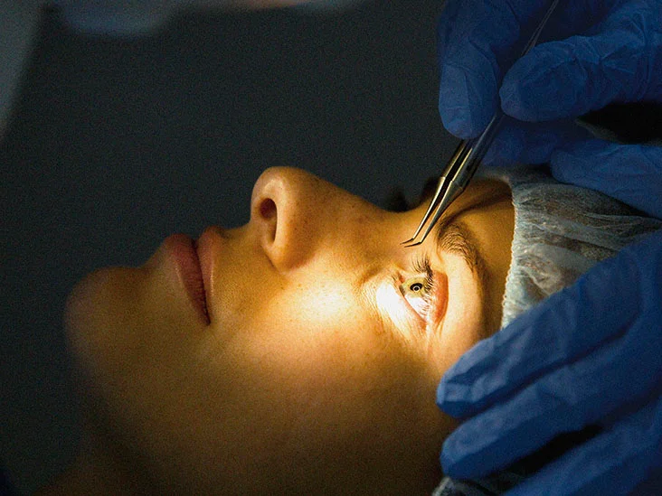 Vitrectomy Surgery in Turkey: Cost, Procedure and Recovery