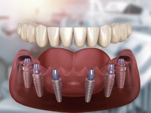 All on 6 Dental Implants in Turkey, Antalya –Costs and Packages