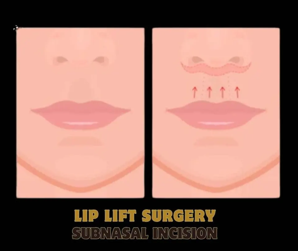 (bullhorn) subnasal lif lifting technique