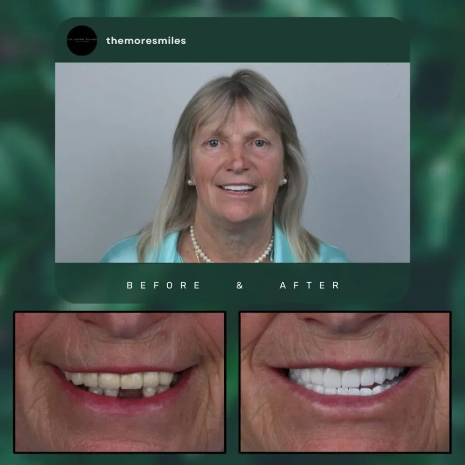 Dental before & after 43