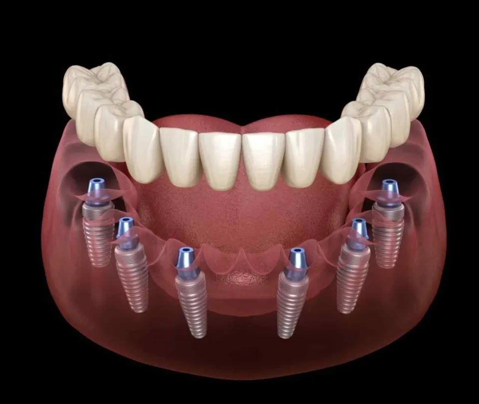 all on 6 full set of dental implants cost turkey