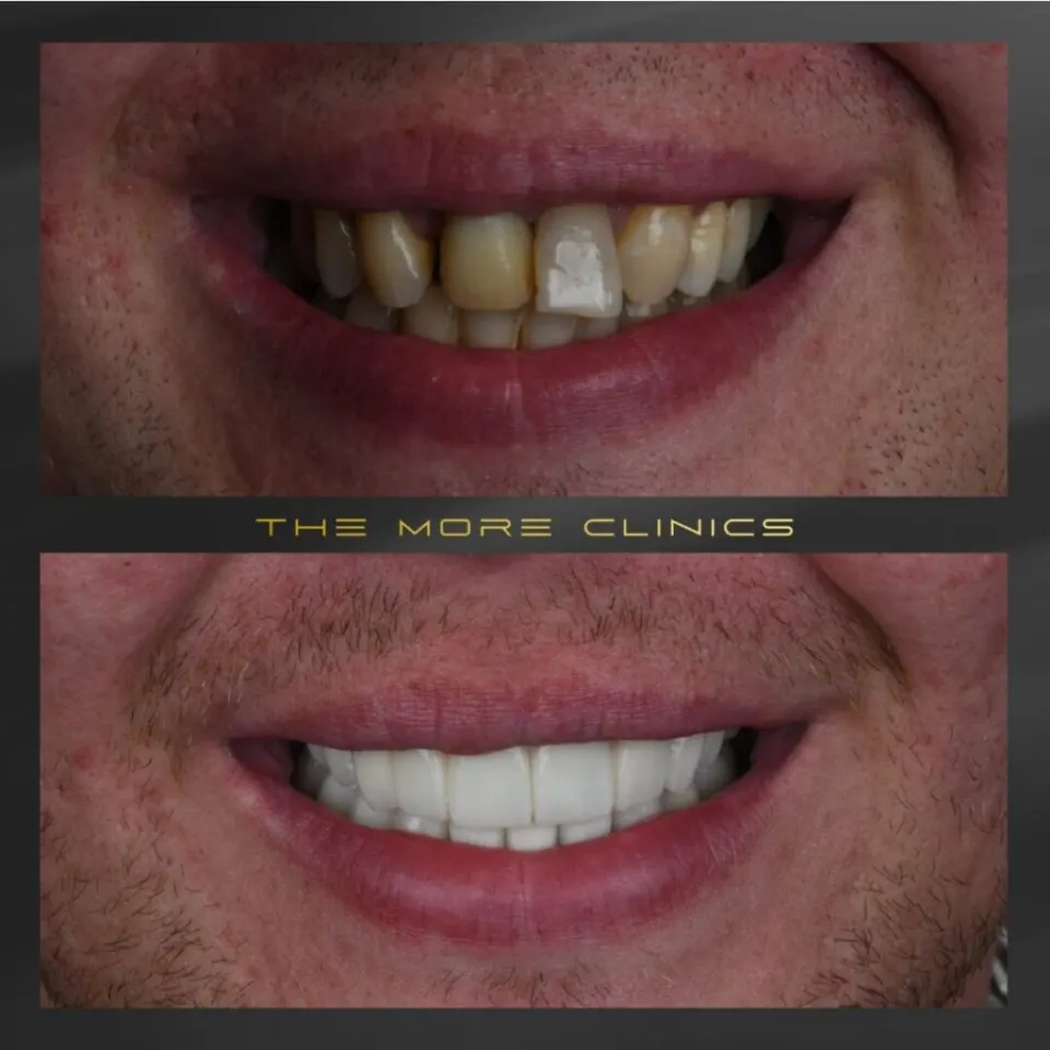 Tooth Dental crowns before and after full smile restoration Turkey