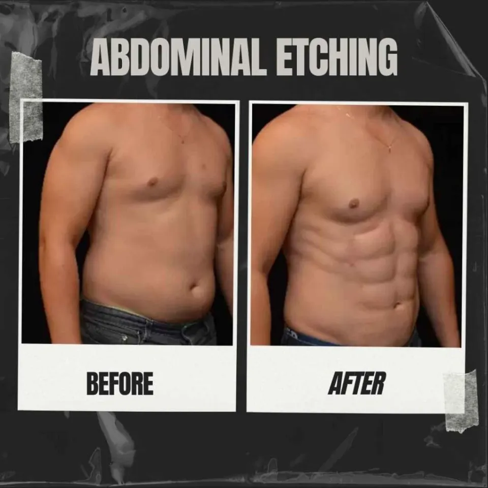 abdominal etching before and after male patient