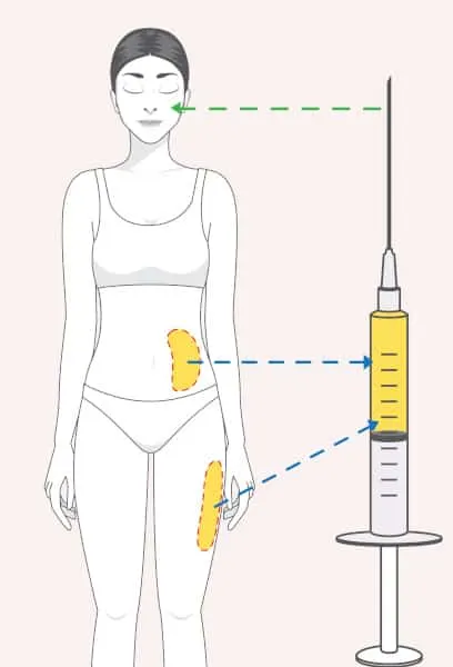 fat transfer to face after harvesting from thighs and abdomen