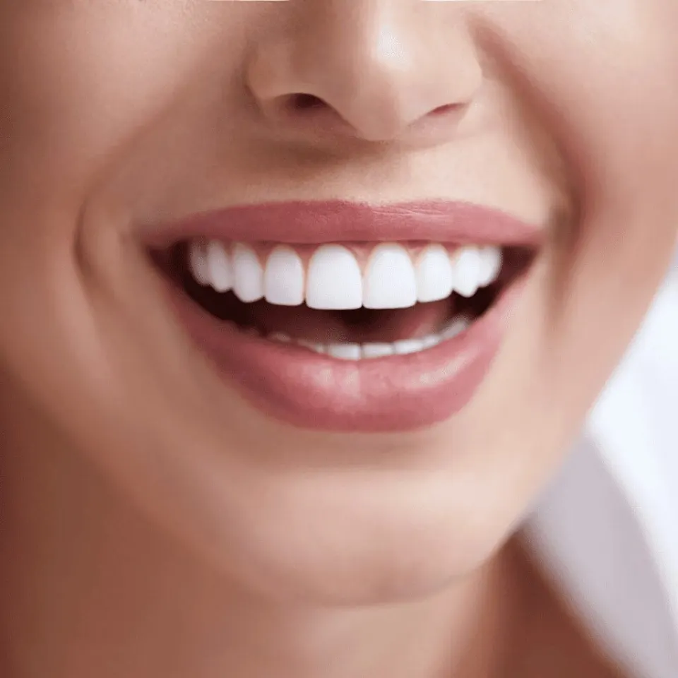 Antalya Smile Makeover