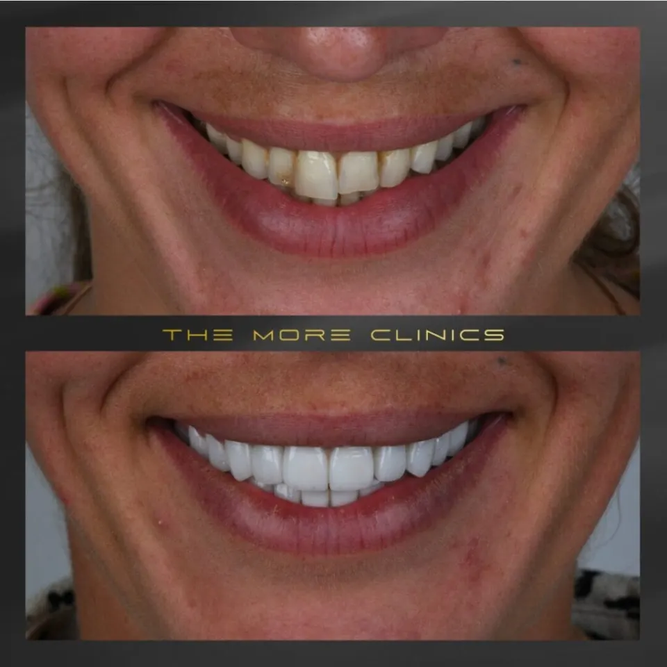 dental veneers turkey before and after hollywood smile design (antalya)