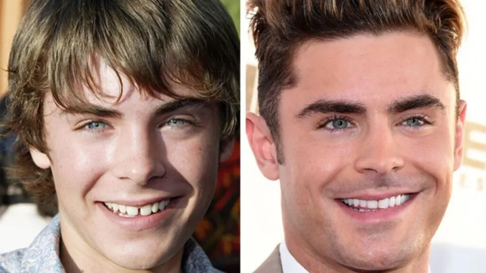 zac efron teeth before and after