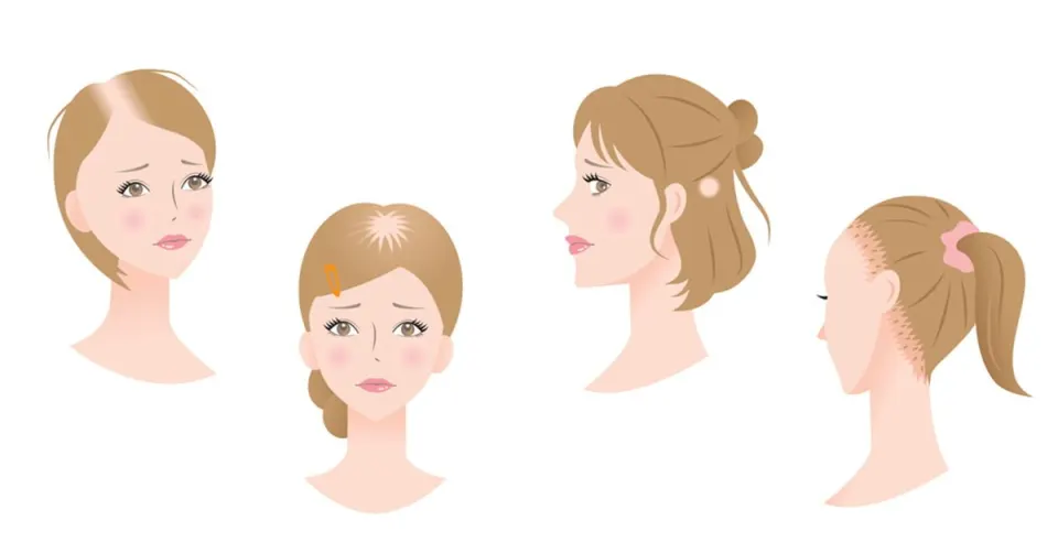 hair loss due to tension , traction alopecia