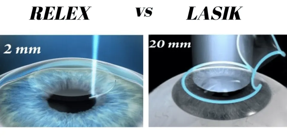 relex smile vs lasik