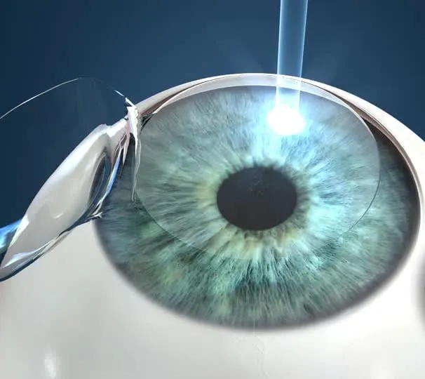 Antalya Ilasik Eye Laser Surgery