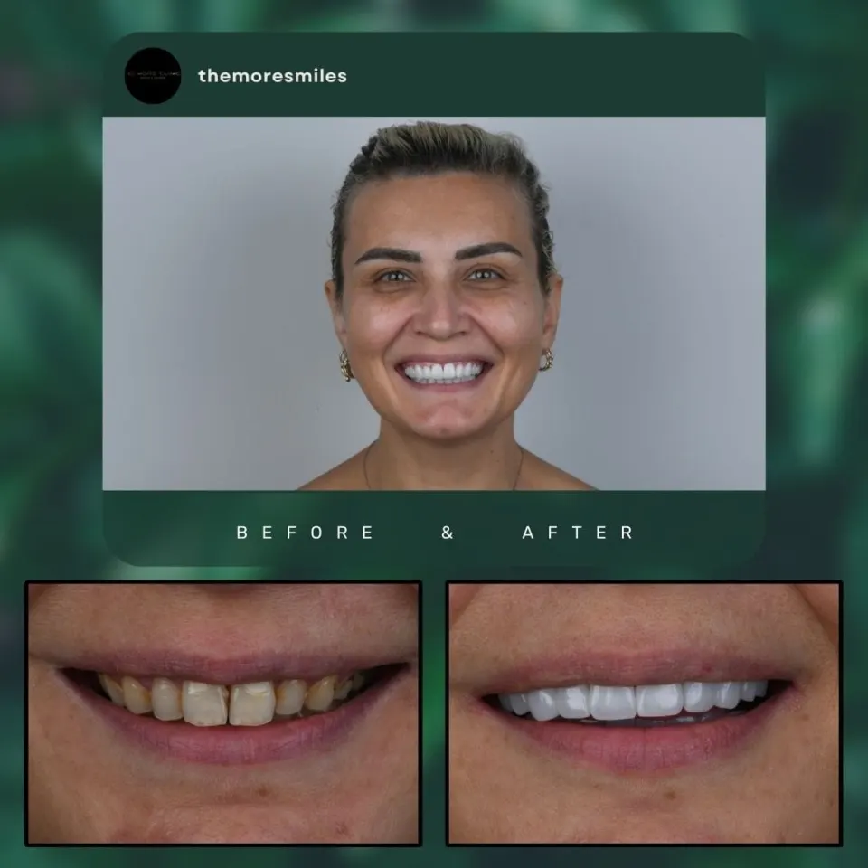 Dental before & after 32