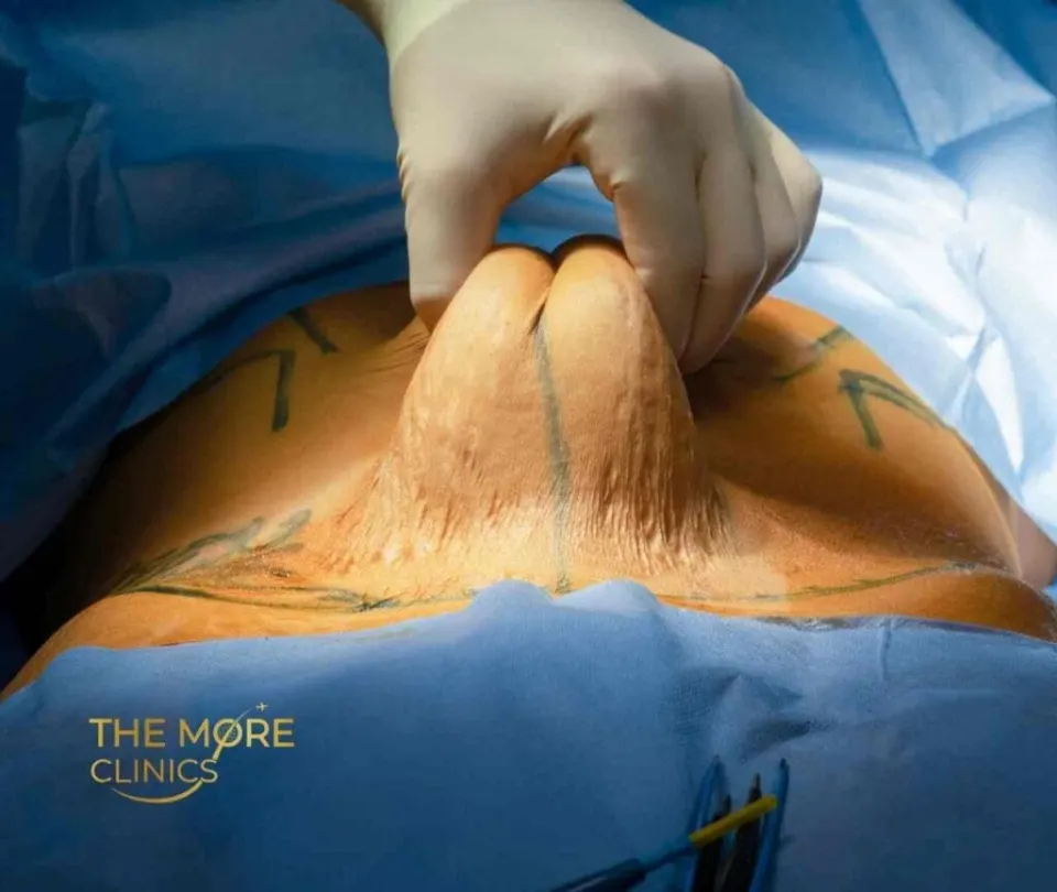 best tummy tuck surgeon turkey