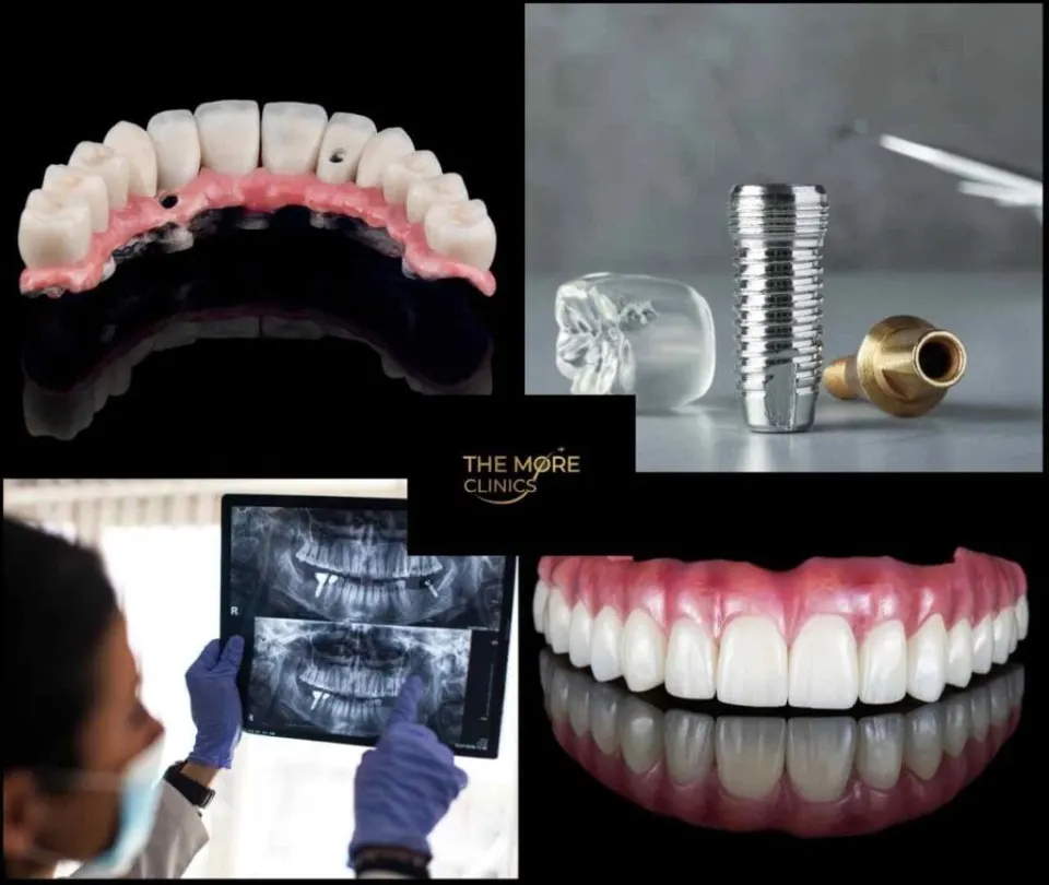 Types d’implants pour arcade complète et leur coût