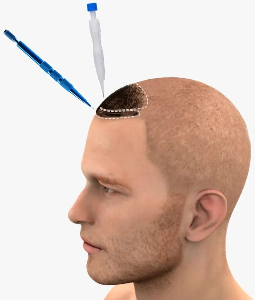 Hair transplantation and restoration — every option compared 2026
