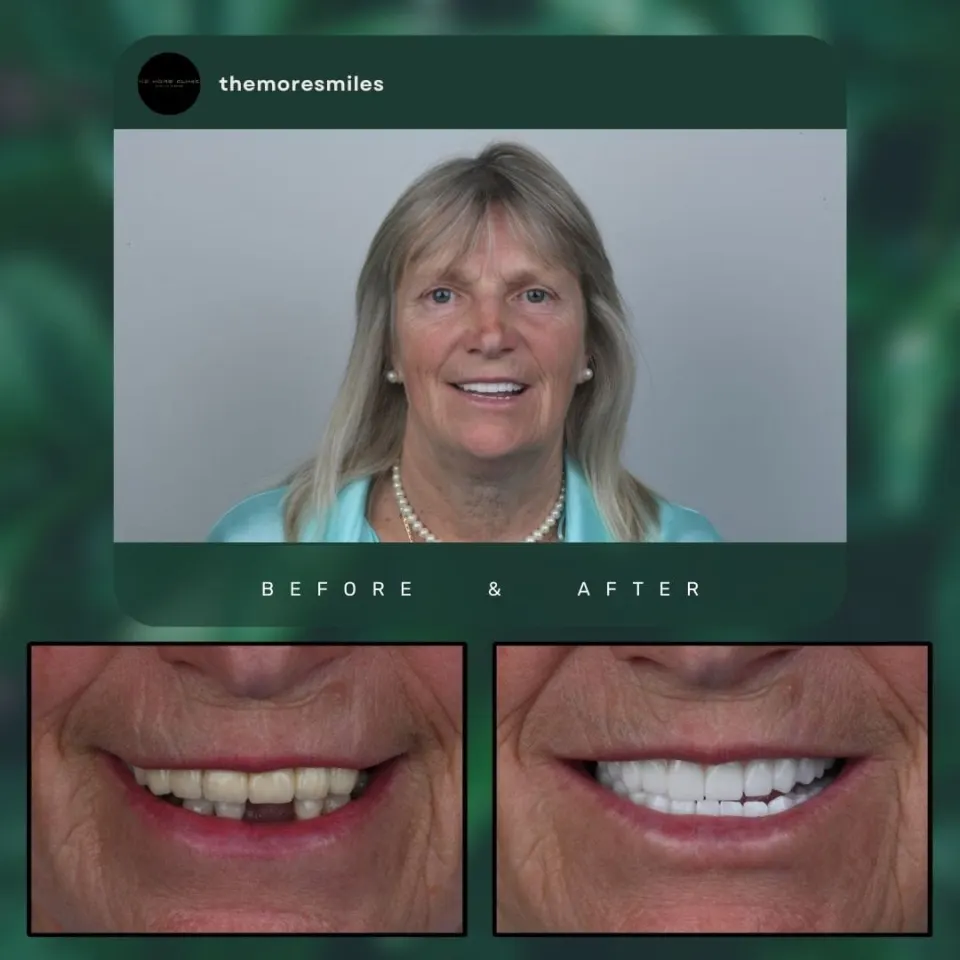 Antalya Dental Veneers