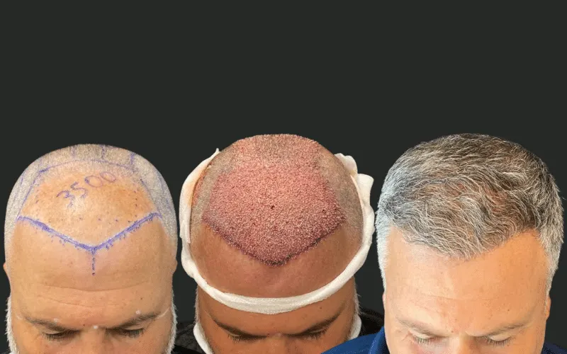 Hair-transplant results 1