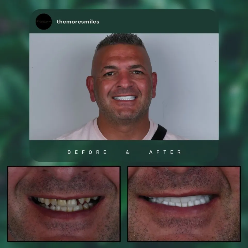 Dental before & after 53