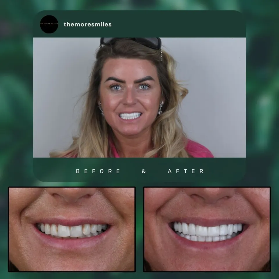 Dental before & after 52