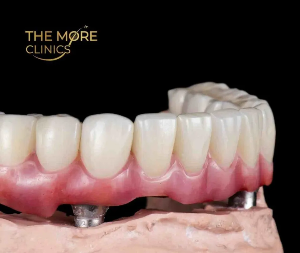 all on four turkey teeth implants advantages