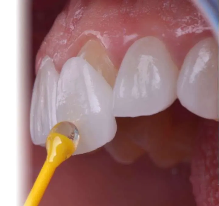 Antalya Dental veneers