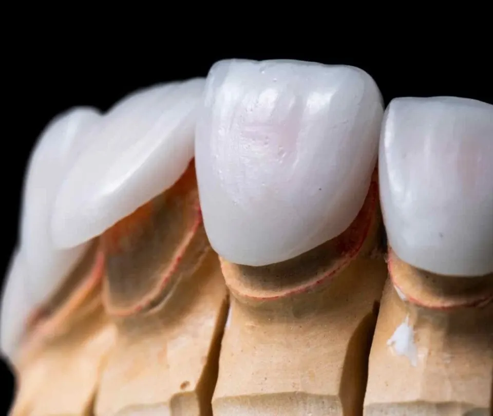 Zahn-Veneers in der Türkei: Kosten, Laminate Veneers