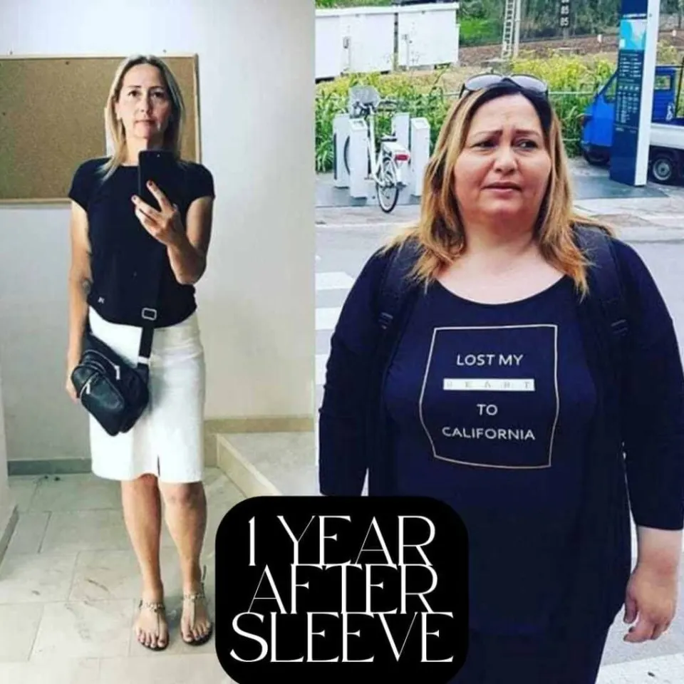 gastric sleeve before and after woman