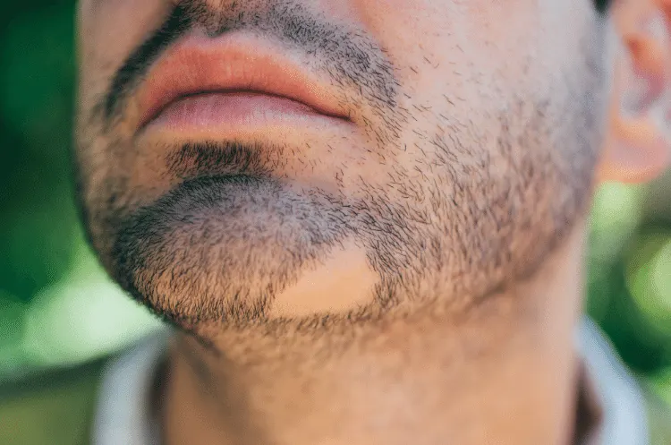 alopecia barbae Turkey