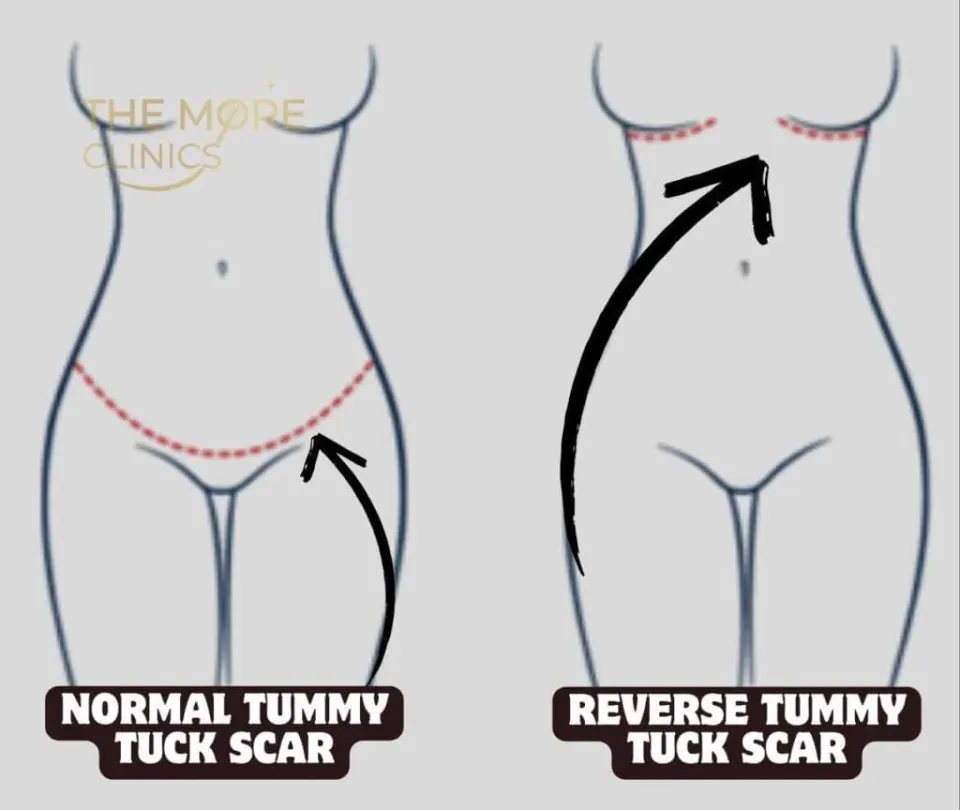cicatrice de la plastie abdominale inversée vs cicatrice de la plastie abdominale normale