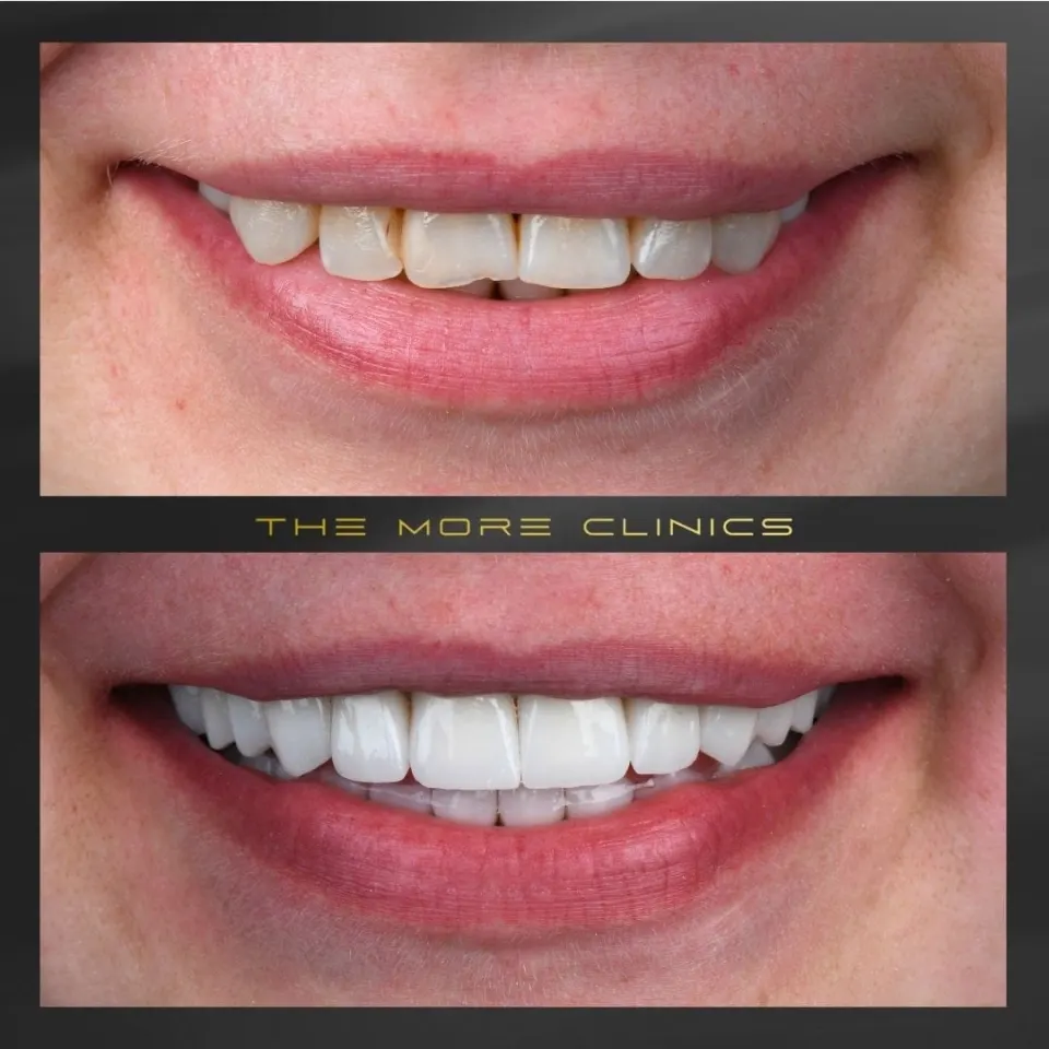 Dental before & after 19