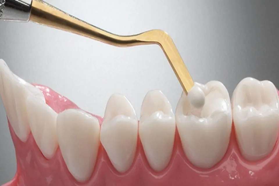 Antalya Metal Fillings