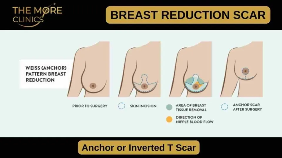 breast reduction surgery scar anchor shaped