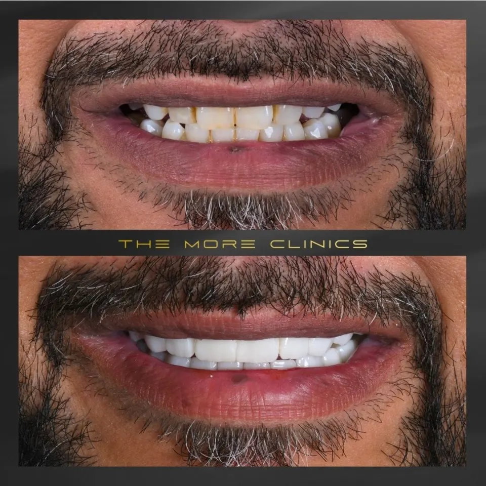 Dental before & after 17