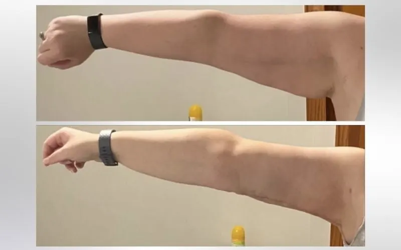 (brachioplasty) arm lift before and after