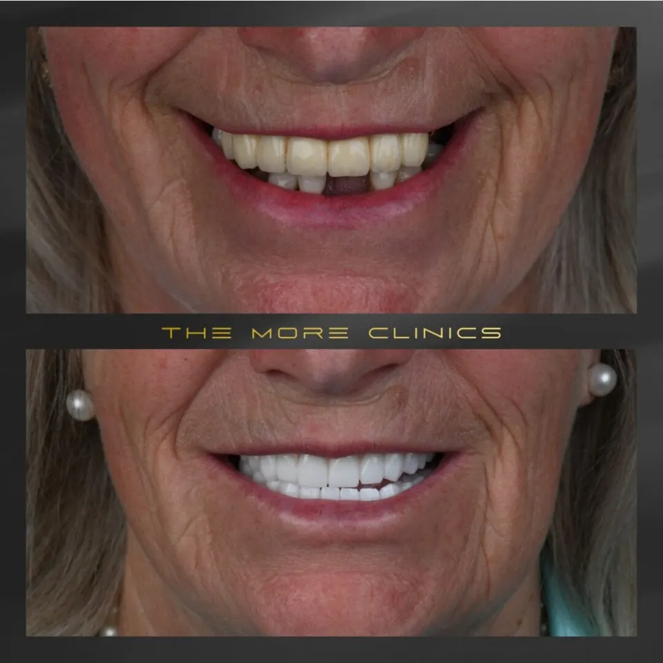 smile mkaeover before and after with implants and crowns