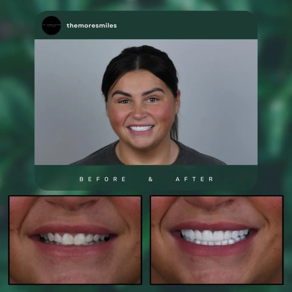 Dental veneers before and after — E-Max porcelain veneers Antalya