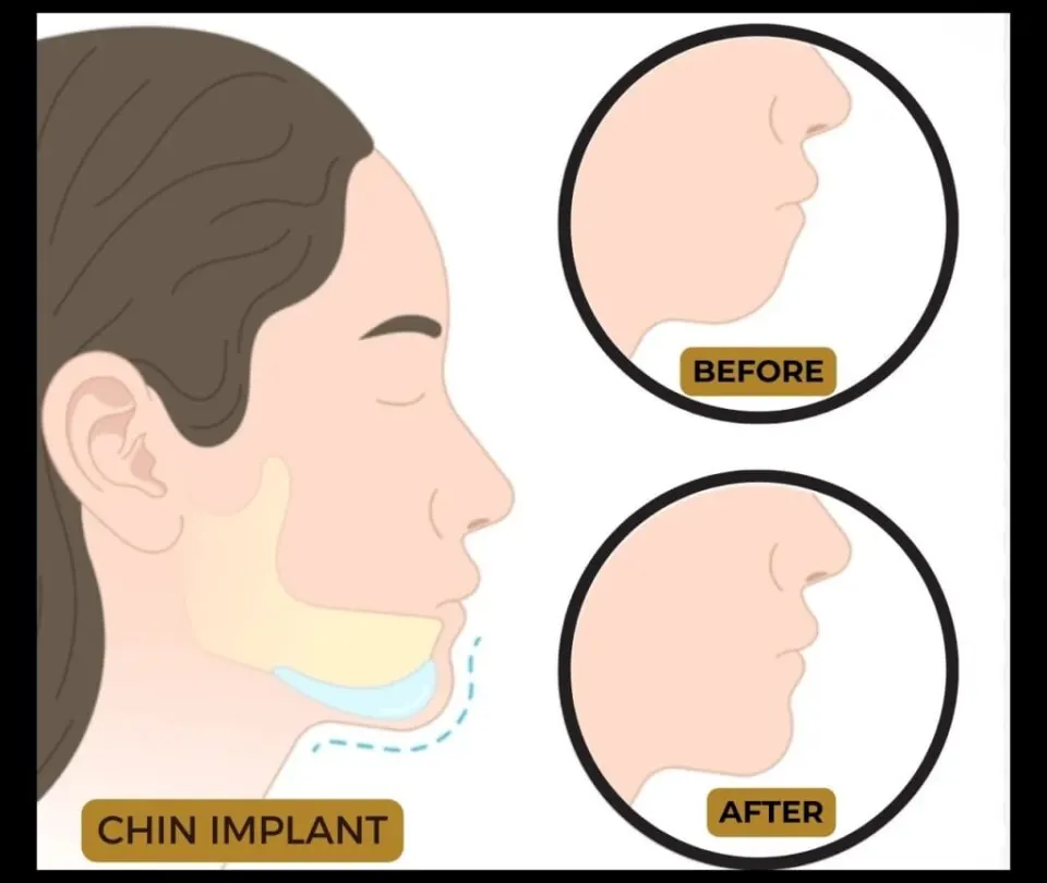 what is geinoplasty chin augmentation