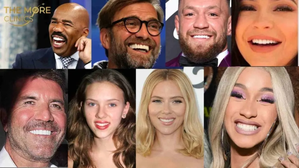 celebrities with veneers before and after
