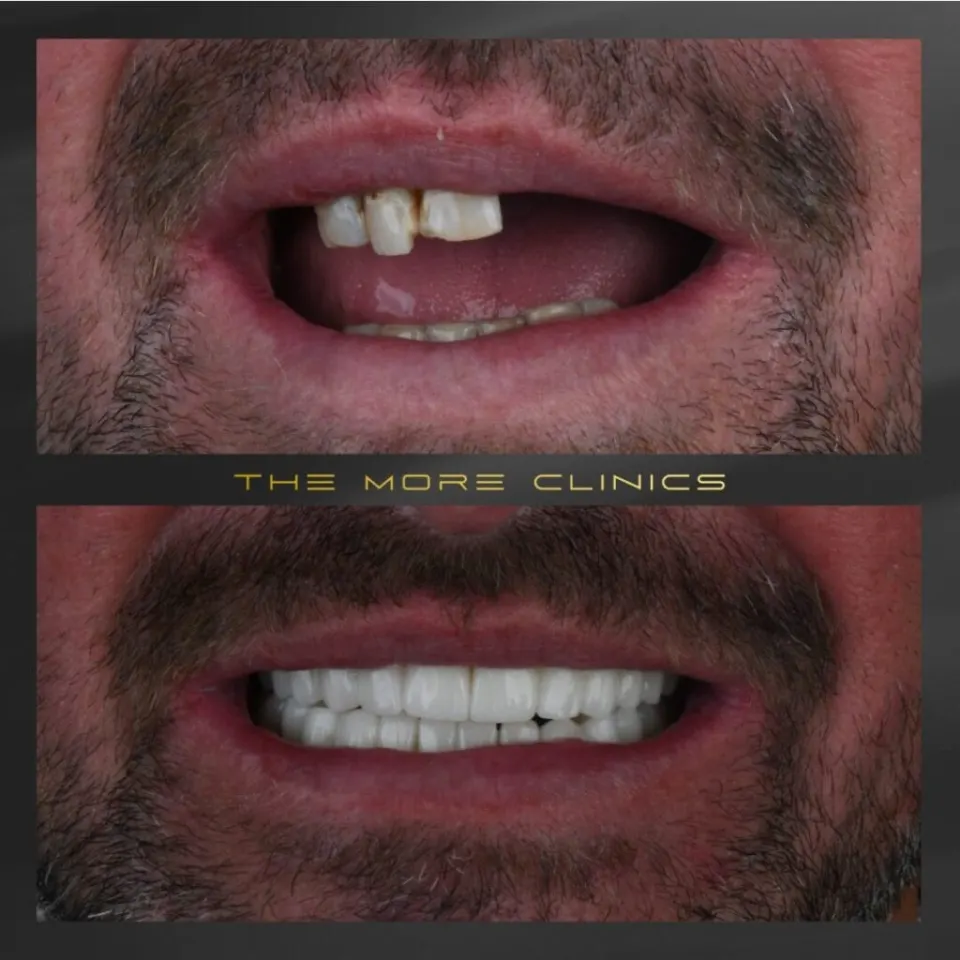Dental crown before and after — full smile restoration zirconia