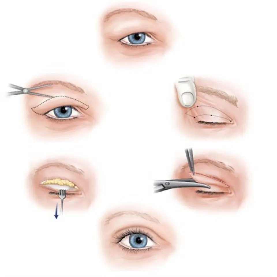 eyelid surgery blephoraplasty turkey