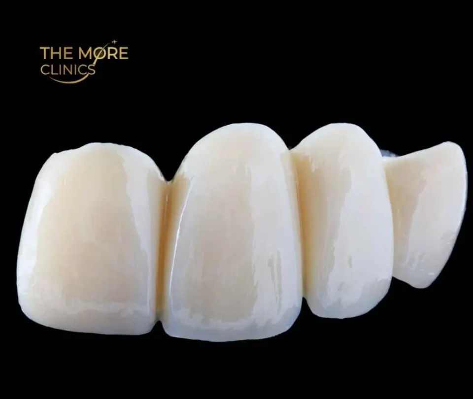 Traditional dental bridge — how it works, cost and types