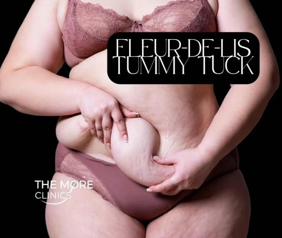 fleur de lis abdominoplasty turkey candidate