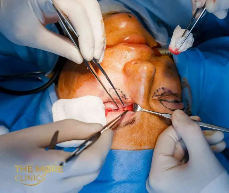 Upper blepharoplasty surgery procedure details — eyelid surgery