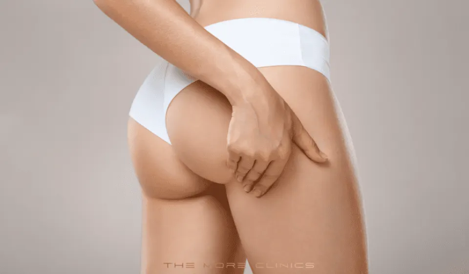 BBL Turkey before and after — brazilian butt lift cost vs UK, USA and Germany 2026