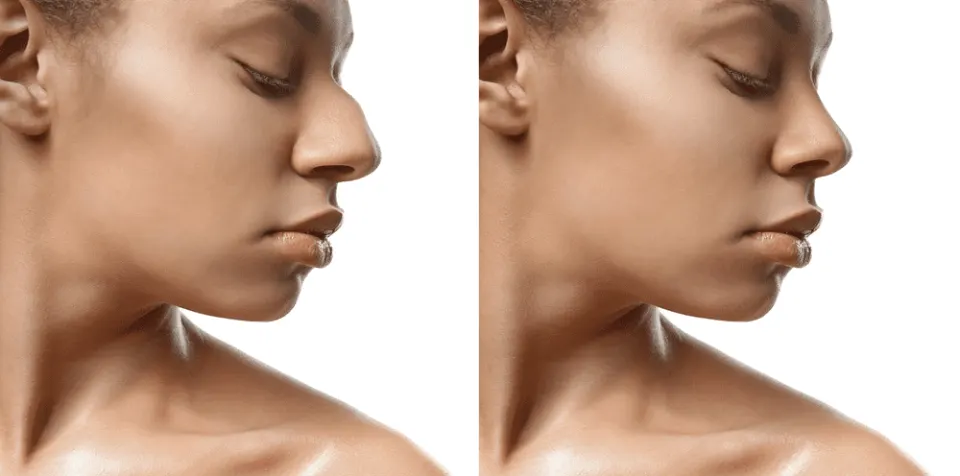 Rhinoplasty (Nose Job) in Turkey: Cost, Techniques & Packages