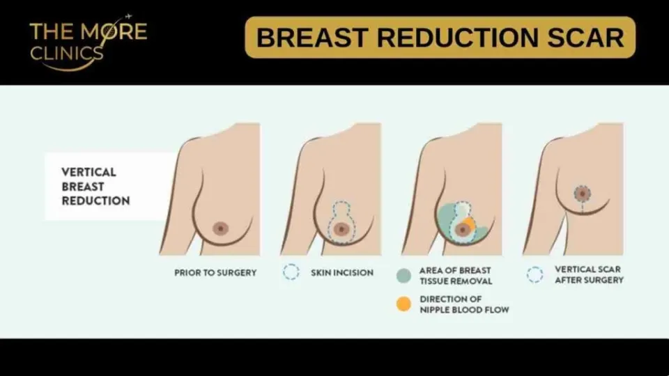 breast reduction surgery scar pattern