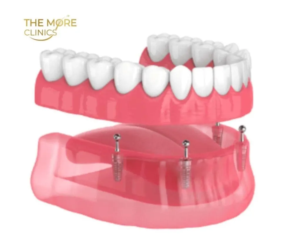snap in dentures cost turkey affordable
