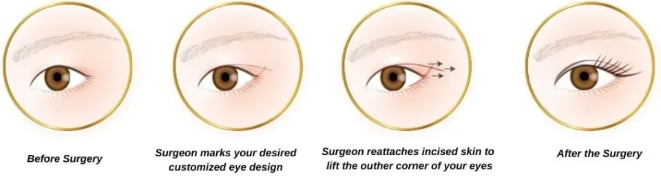 cat eye surgery (Canthopexy) how its being performed