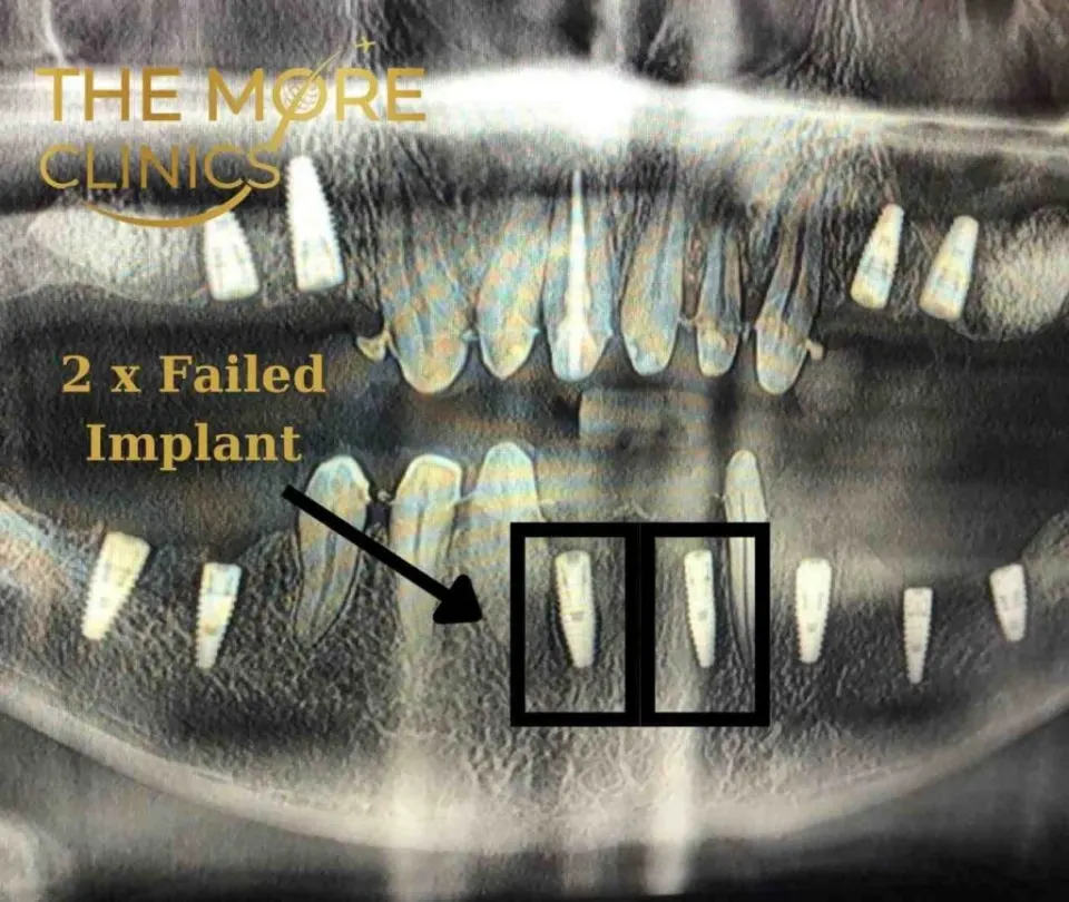 2 x Failed Dental Implant X Ray