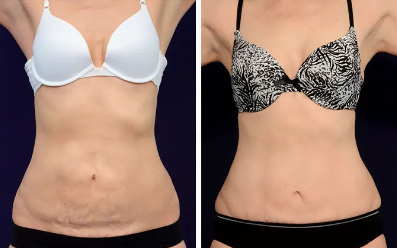 tummy tuck abdominoplasty before and after