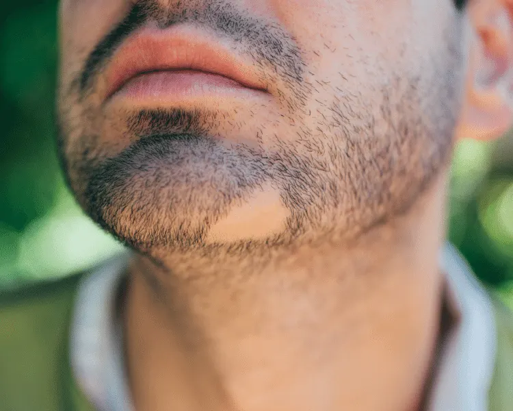 alopecia barbae causes of beard baldness